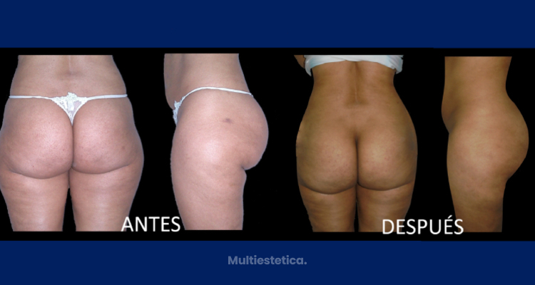“El aumento de glúteos con implantes tiene mayor fiabilidad y predictabilidad”