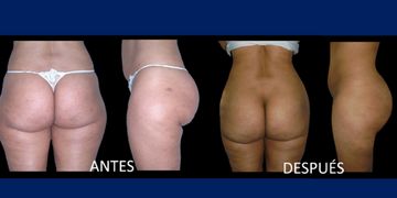 “El aumento de glúteos con implantes tiene mayor fiabilidad y predictabilidad”