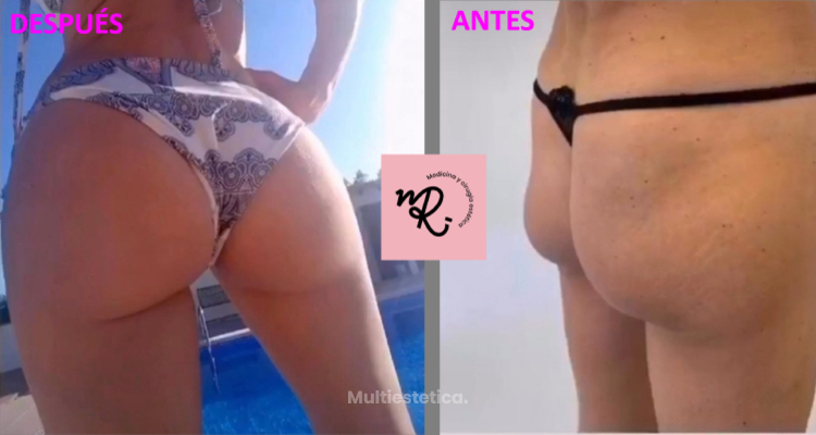Glúteos al poder