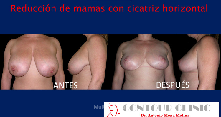 Reducción de mamas con menos cicatrices gracias a la cicatriz horizontal