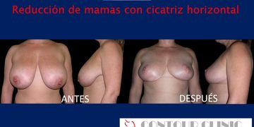 Reducción de mamas con menos cicatrices gracias a la cicatriz horizontal Reducción de mamas con menos cicatrices gracias a la cicatriz horizontal