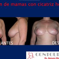 Reducción de mamas con menos cicatrices gracias a la cicatriz horizontal