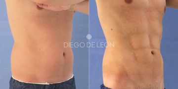 La cirugía del 2021: Lipo VASER La cirugía del 2021: Lipo VASER