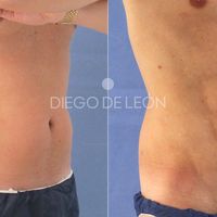 La cirugía del 2021: Lipo VASER