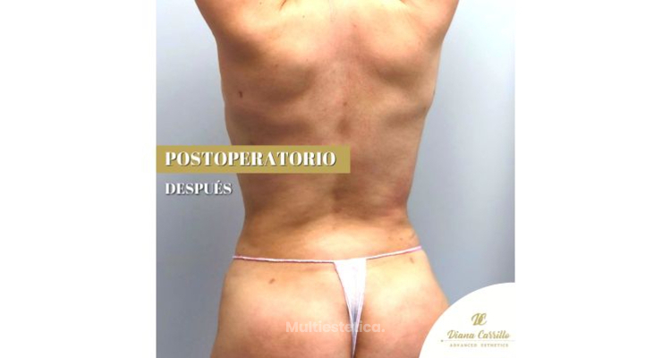 Postoperatorio combinando las mejores técnicas de estética colombiana