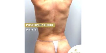 Postoperatorio combinando las mejores técnicas de estética colombiana Postoperatorio combinando las mejores técnicas de estética colombiana