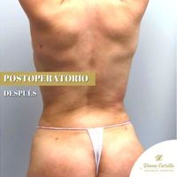 Postoperatorio combinando las mejores técnicas de estética colombiana