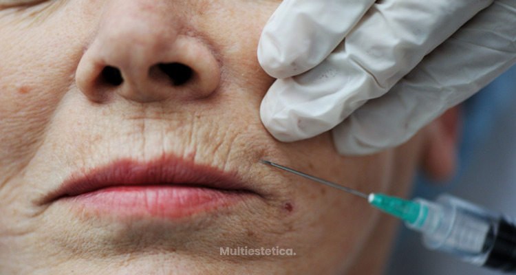 Tratamientos médico-estéticos para hacer desaparecer las arrugas del surco nasogeniano