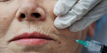 Tratamientos médico-estéticos para hacer desaparecer las arrugas del surco nasogeniano