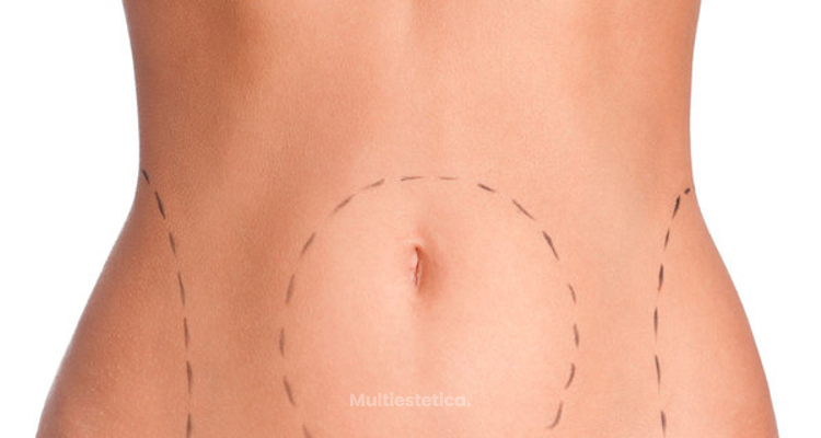 Liposucción y lipoescultura