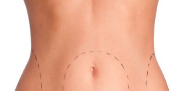 Liposucción y lipoescultura