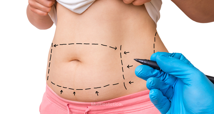 ¿Por qué te ofrecemos la alternativa a la abdominoplastia quirúrgica?