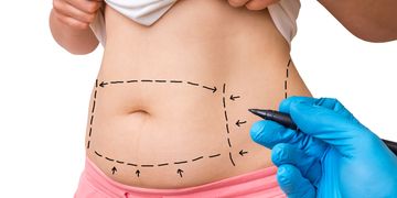 ¿Por qué te ofrecemos la alternativa a la abdominoplastia quirúrgica? ¿Por qué te ofrecemos la alternativa a la abdominoplastia quirúrgica?