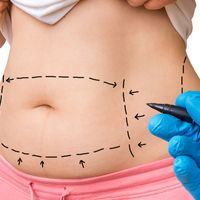 ¿Por qué te ofrecemos la alternativa a la abdominoplastia quirúrgica?