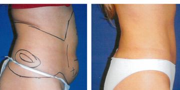 "Los resultados definitivos de la hidrolipoclasia se ven al tercer y sexto mes" "Los resultados definitivos de la hidrolipoclasia se ven al tercer y sexto mes"