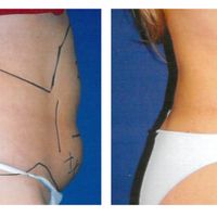 "Los resultados definitivos de la hidrolipoclasia se ven al tercer y sexto mes"