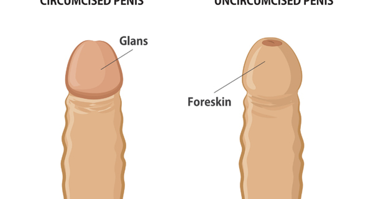 Fimosis o circuncisión