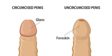 Fimosis o circuncisión