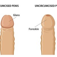 Fimosis o circuncisión
