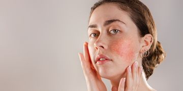 Tipos de rosácea en la cara y cómo combatirla