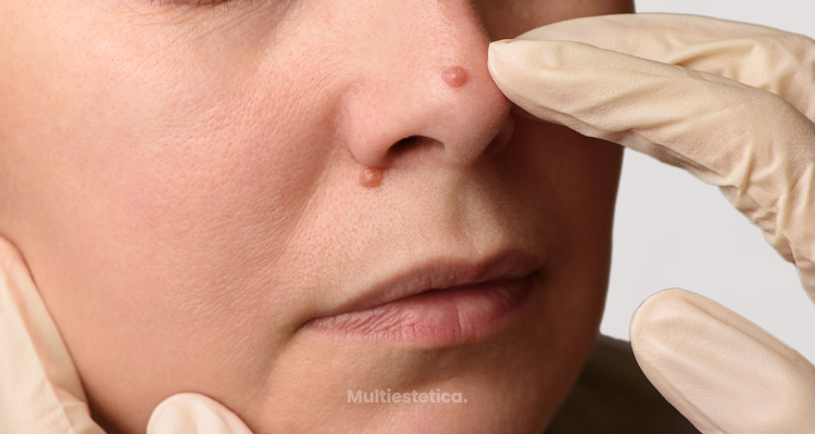 Las verrugas en el cuello y la cara: cómo tratarlas