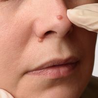 Las verrugas en el cuello y la cara: cómo tratarlas