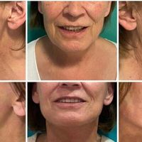 El postoperatorio del lifting facial: 15 preguntas frecuentes