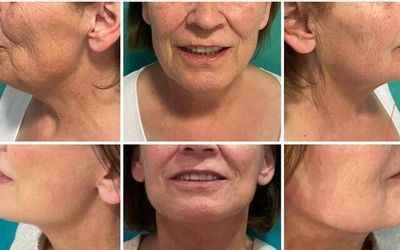 El postoperatorio del lifting facial: 15 preguntas frecuentes