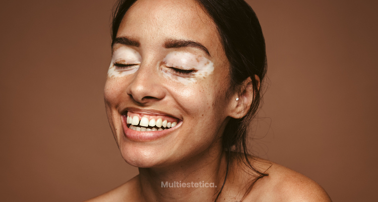 Qué hacer cuando se tiene vitiligo