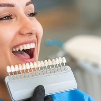 10 beneficios de las carillas dentales