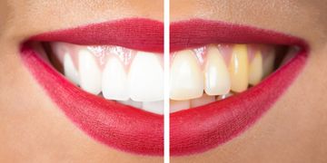 ¿Dientes amarillos o desalineados? Descubre cómo las carillas dentales pueden transformar tu sonrisa en minutos