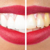 ¿Dientes amarillos o desalineados? Descubre cómo las carillas dentales pueden transformar tu sonrisa en minutos