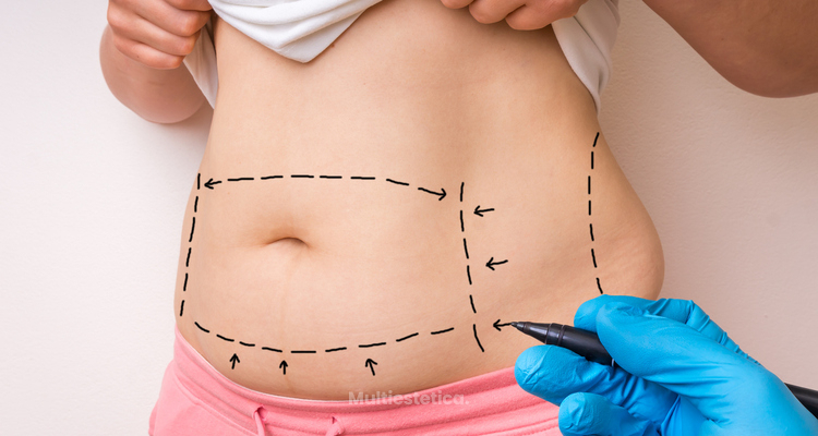 Liposucción mediana: Descubre todo sobre esta popular técnica de remodelación corporal