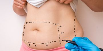 Liposucción mediana: Descubre todo sobre esta popular técnica de remodelación corporal