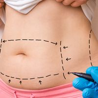 Liposucción mediana: Descubre todo sobre esta popular técnica de remodelación corporal