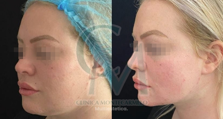 La Bichectomía y Lipofilling facial: Redefiniendo el rostro con naturalidad