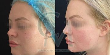 La Bichectomía y Lipofilling facial: Redefiniendo el rostro con naturalidad