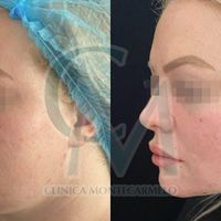 La Bichectomía y Lipofilling facial: Redefiniendo el rostro con naturalidad