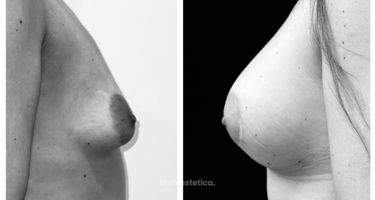 Cambios en la forma de los implantes después de un aumento de pecho: Todo lo que debes saber