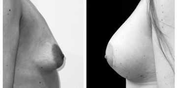 Cambios en la forma de los implantes después de un aumento de pecho: Todo lo que debes saber Cambios en la forma de los implantes después de un aumento de pecho: Todo lo que debes saber