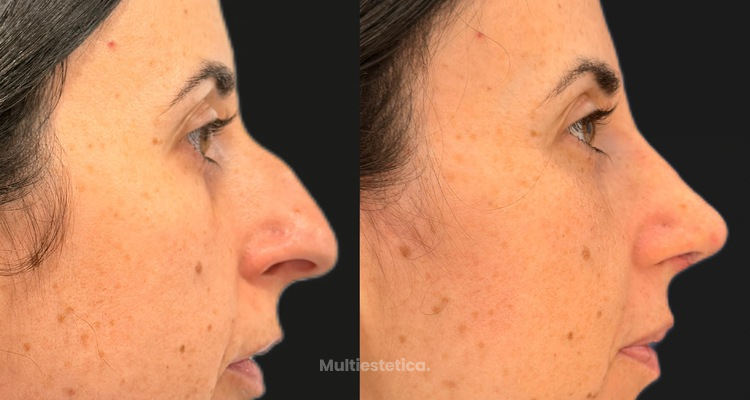 Beneficios de la cirugía de septoplastia y reducción de cornetes nasales realizada conjuntamente con la rinoplastia estética