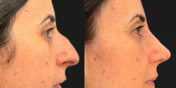 Beneficios de la cirugía de septoplastia y reducción de cornetes nasales realizada conjuntamente con la rinoplastia estética Beneficios de la cirugía de septoplastia y reducción de cornetes nasales realizada conjuntamente con la rinoplastia estética
