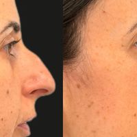 Beneficios de la cirugía de septoplastia y reducción de cornetes nasales realizada conjuntamente con la rinoplastia estética