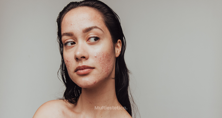 Piel nueva después del acné: los tratamientos más efectivos para cicatrices, textura y manchas