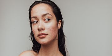 Piel nueva después del acné: los tratamientos más efectivos para cicatrices, textura y manchas