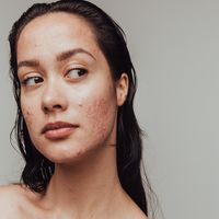 Piel nueva después del acné: los tratamientos más efectivos para cicatrices, textura y manchas