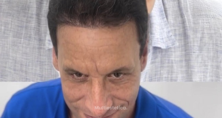 Antes y después reales: cómo recuperamos entradas y línea frontal con FUE Zafiro (Método Capilaris)