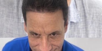 Antes y después reales: cómo recuperamos entradas y línea frontal con FUE Zafiro (Método Capilaris)