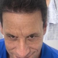 Antes y después reales: cómo recuperamos entradas y línea frontal con FUE Zafiro (Método Capilaris)