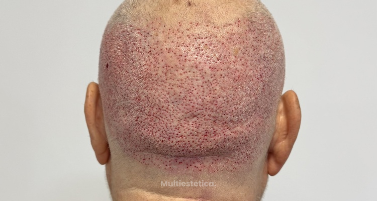 Postoperatorio del trasplante capilar: guía día a día y mes a mes (Método Capilaris)